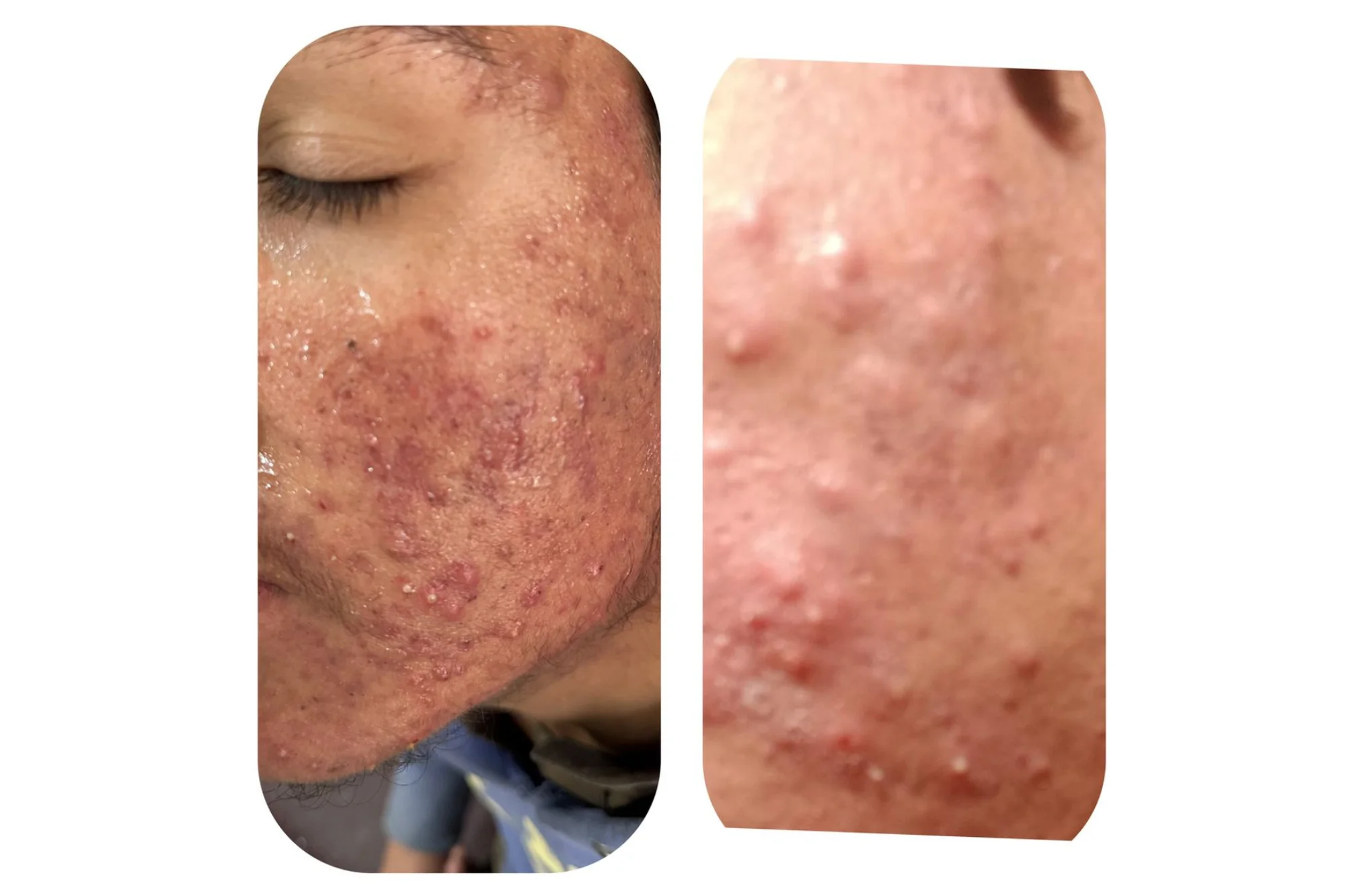 Skin Transformation